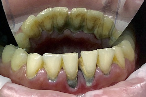 Удаление зубного камня – описание процедуры и результат